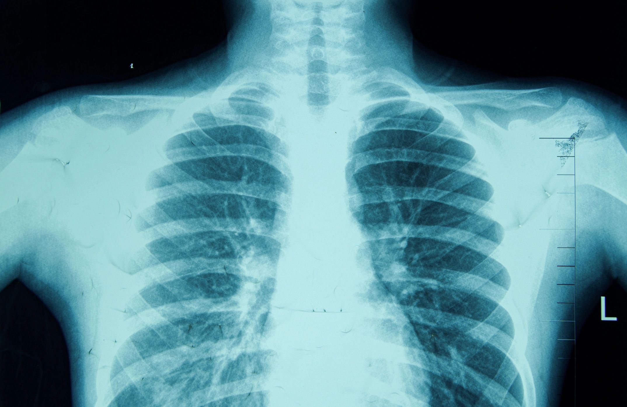 Thoracic cavity X-ray showing chest anatomy